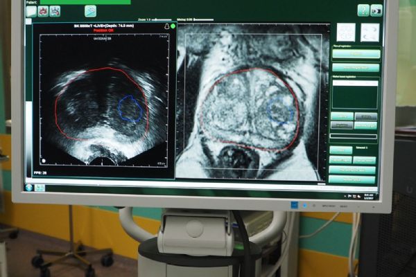 Nová technologie urologů FN Plzeň zachytí nádor přesněji 