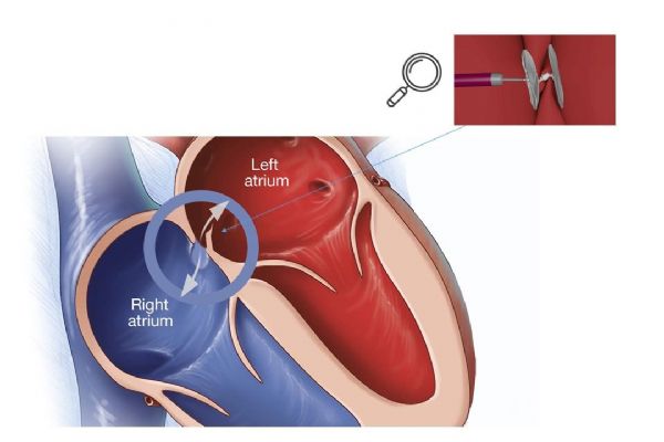 Kardiologové KKN zavedli do svého portfolia novou metodu 