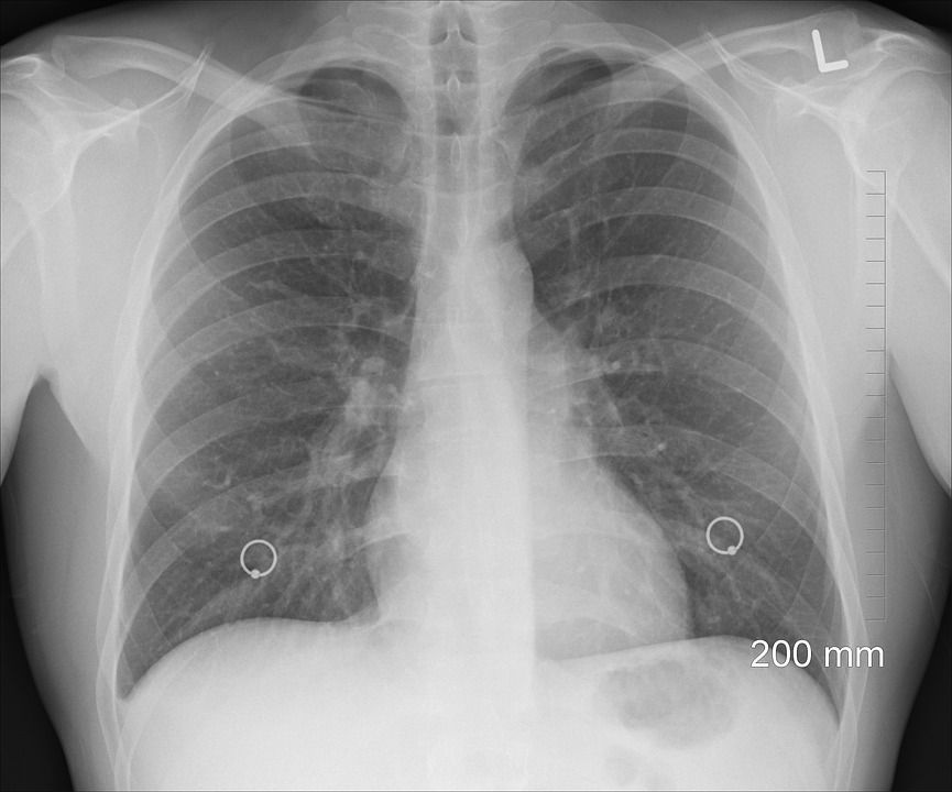 Zaměstnanci Borgersu v Hrádku musí na rentgen, jeden z cizinců má tuberkulózu 